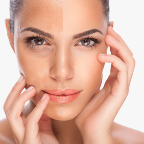 VivaMD RF Microneedling