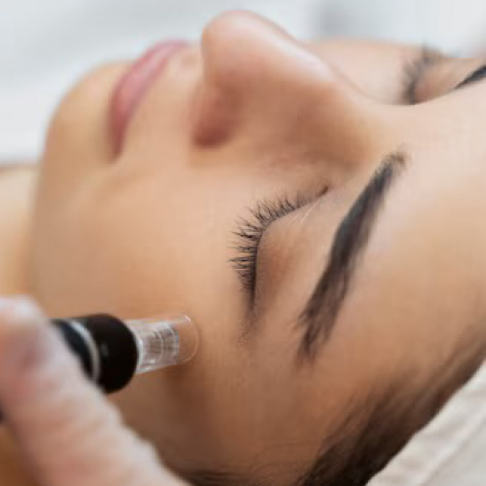 Microneedling (Face Only) at SOL SKN Aesthetics in Franklin, TN
