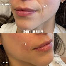 Smile Lines