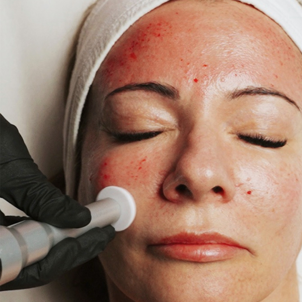 Procell Microchanelling at Luxe Skin by Lex in Teaneck Road, NJ