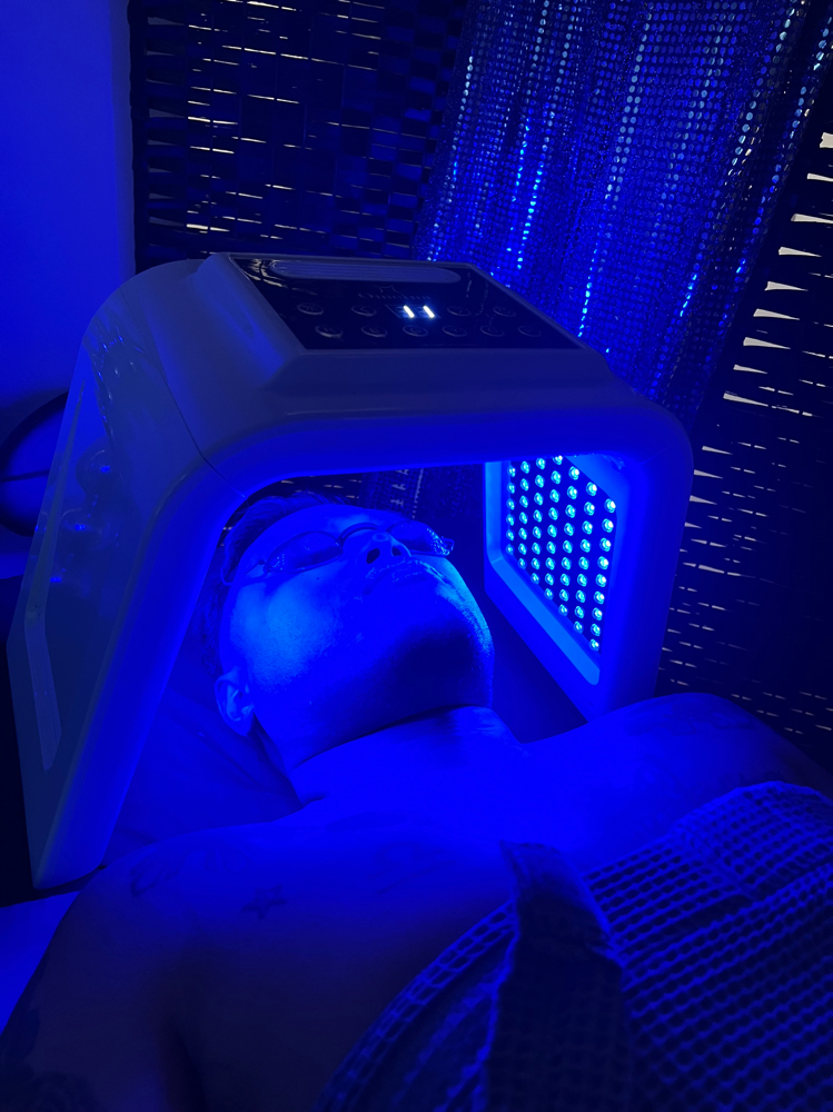 Acne Facial