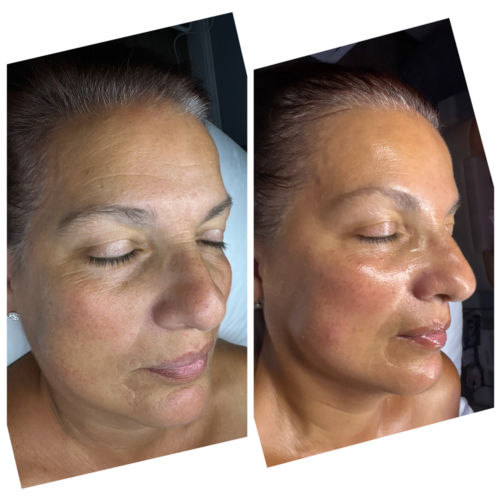 Corrective Facial at Serenity By Sarina in Riverside, RI