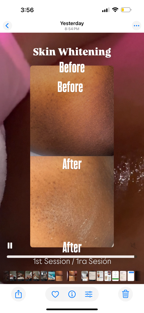 Inner Thighs Lightening- 1  Session