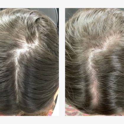 PRF Hair Restoration- 3 Treatments