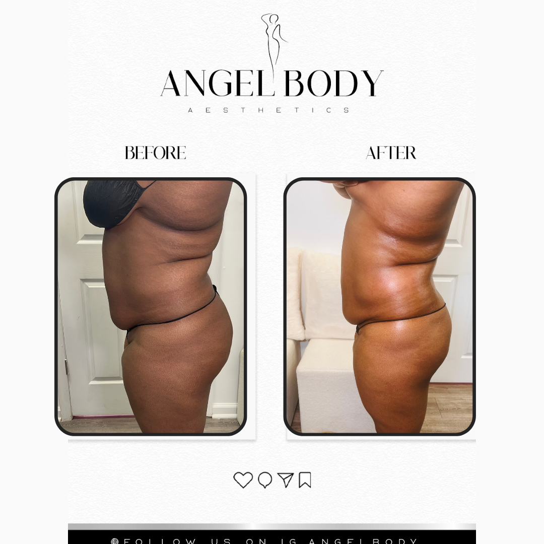 Lemon Bottle Fat Dissolvers at Angel Body Aesthetics in Columbia, MD
