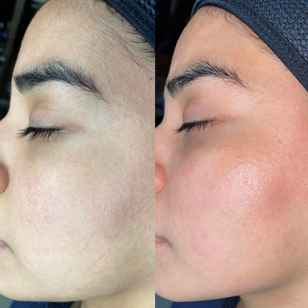 Dermaplaning Facial