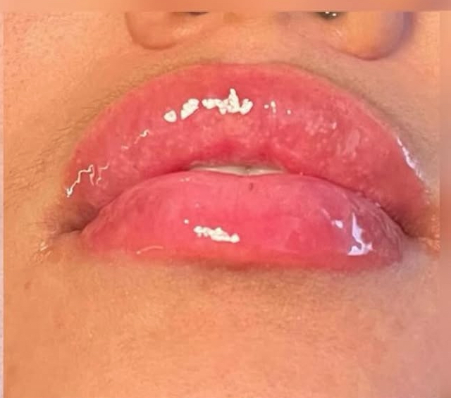 Needless Lip Filler