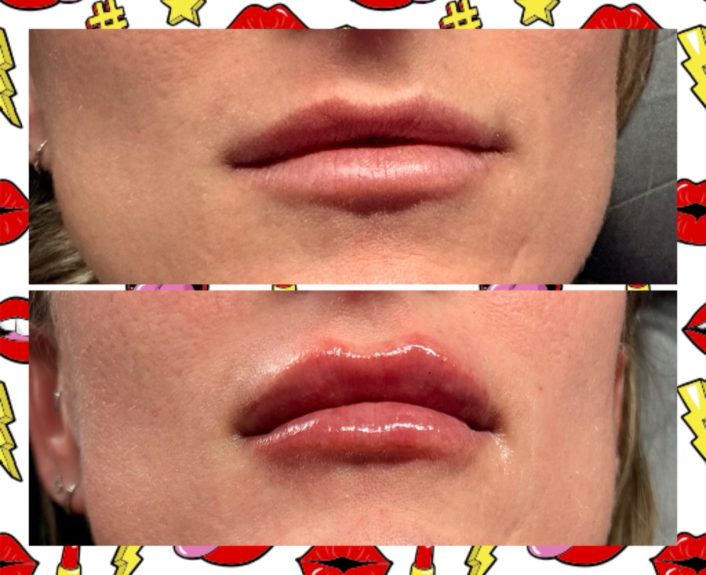 1 ML NEEDLESS HA LIP FILLER at B.A.M. Beauty Bar in Bluff Dale, TX