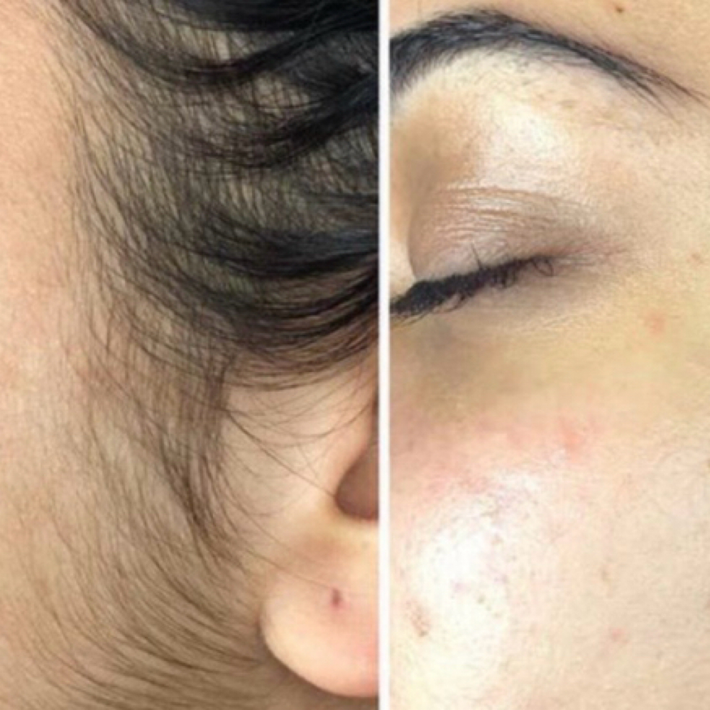 Dermaplaning at Sarah’s Hair Studio in Longmont, CO