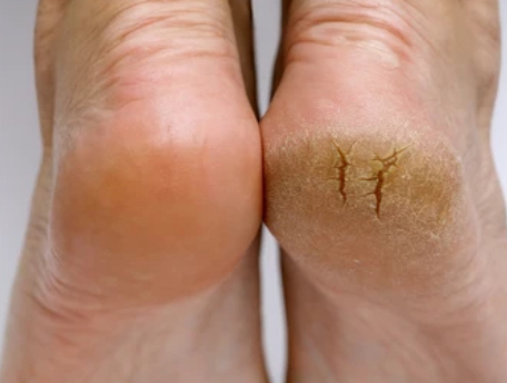 Foot Facial W/Callous Removal at Signature Skin Spa in Scottsdale, AZ