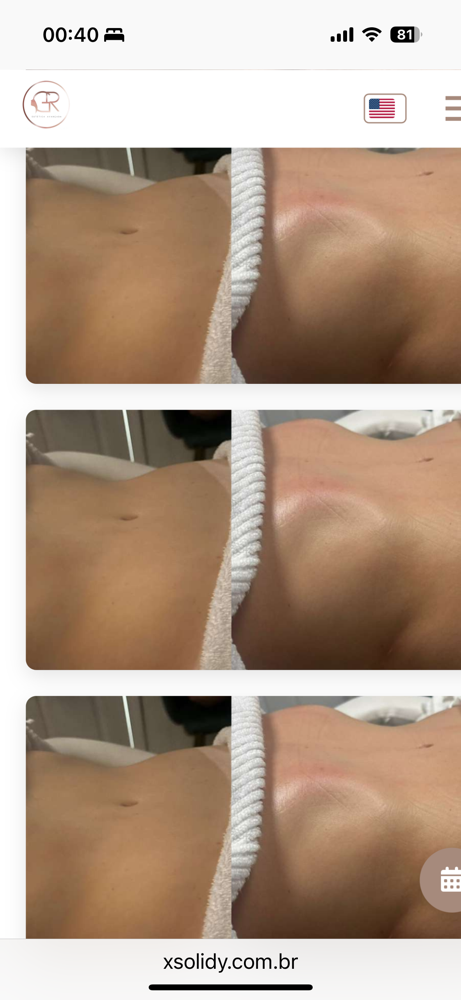 Brazilian Lymphatic Drainage