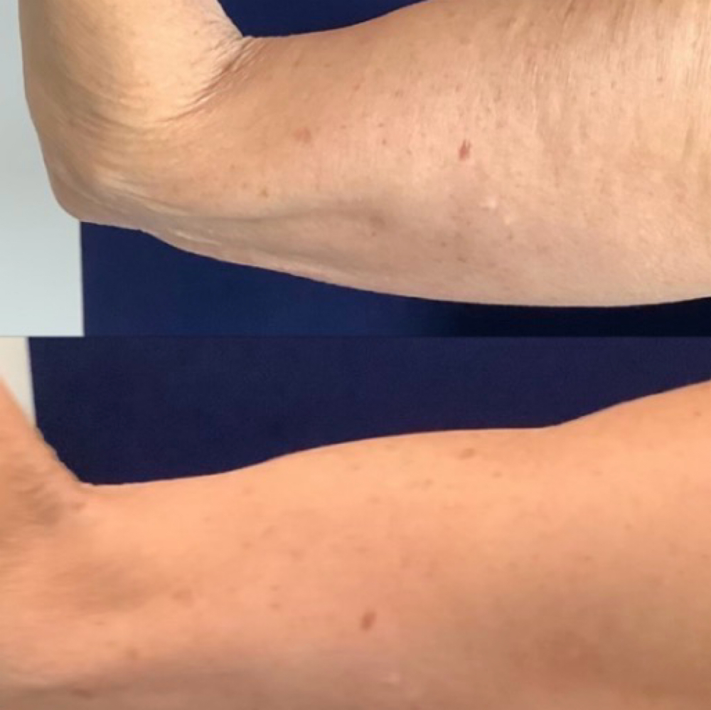Bat Wings 3-session bundle at Silhouette Body Sculpting LLC in St. Peter’s, MO