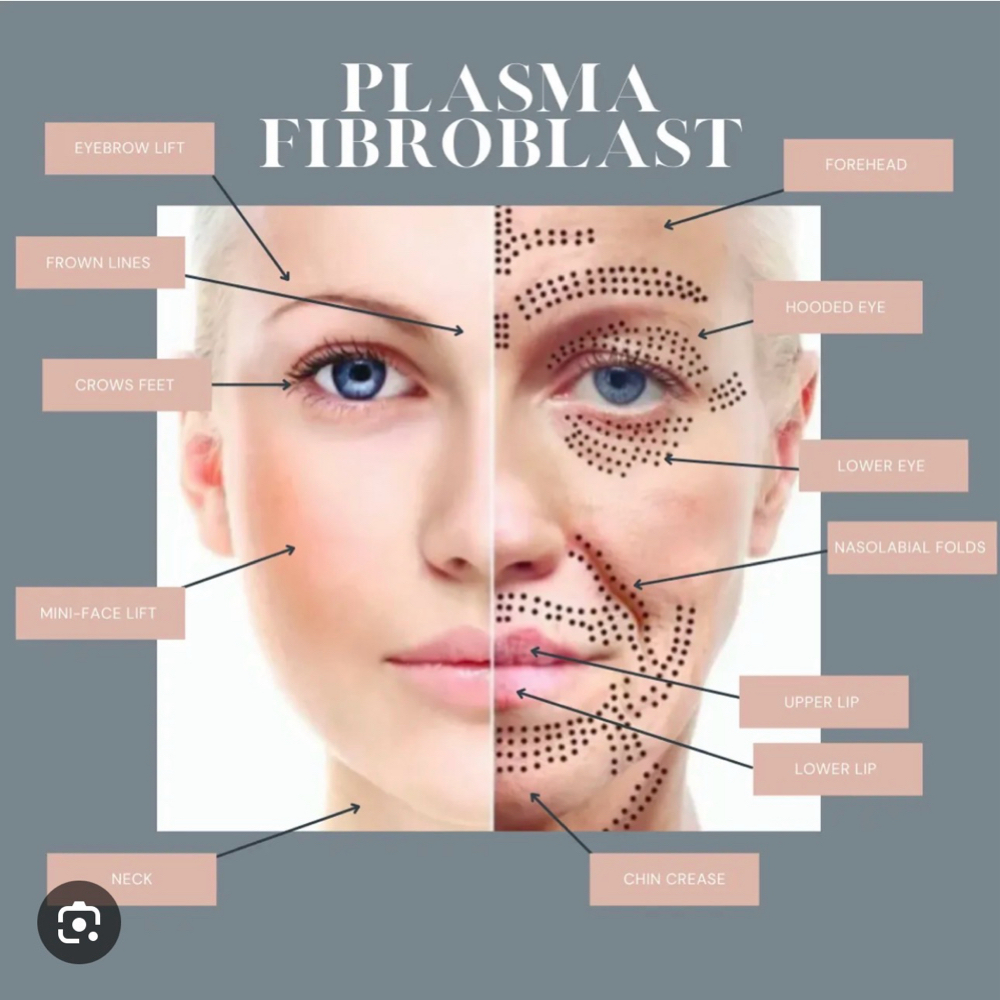 Fibroblast at ELITE DERM in Staten Island, NY