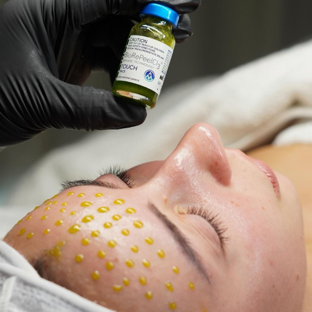 BioRePeel Advanced Skin Renewal at Skin Wellness by Tina in Naperville, IL