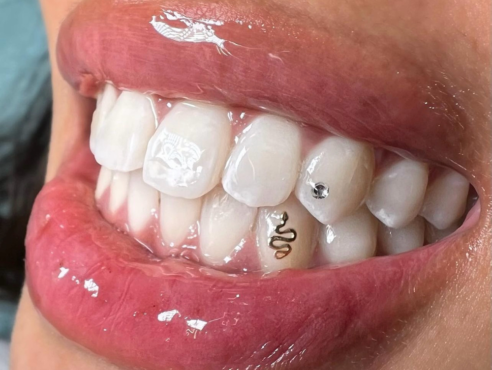 Tooth Gems + Teeth Whitening