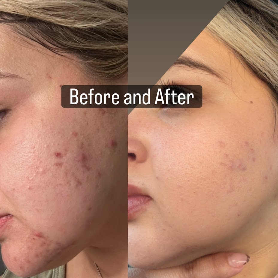 Acne Control Beauty Facial at Santana Skin Studio in El Paso, TX