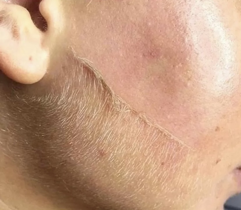 Express Dermaplane