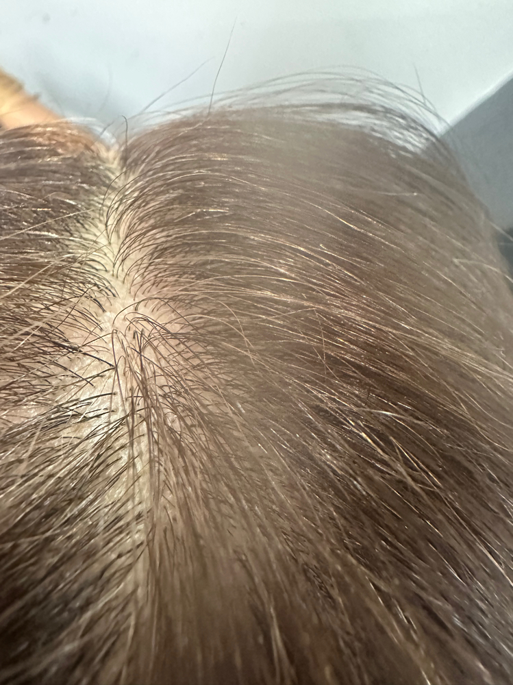 Hair Scalp Analysis