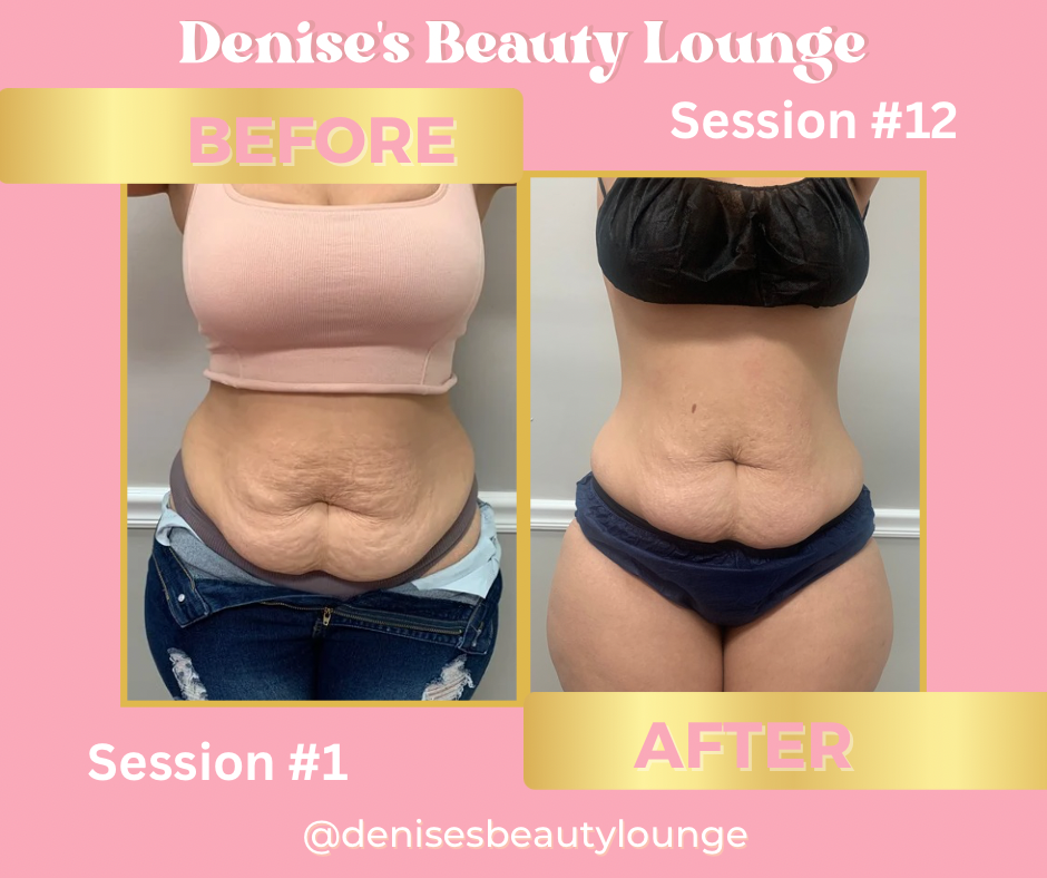 Body Contouring Package-12 Sessions