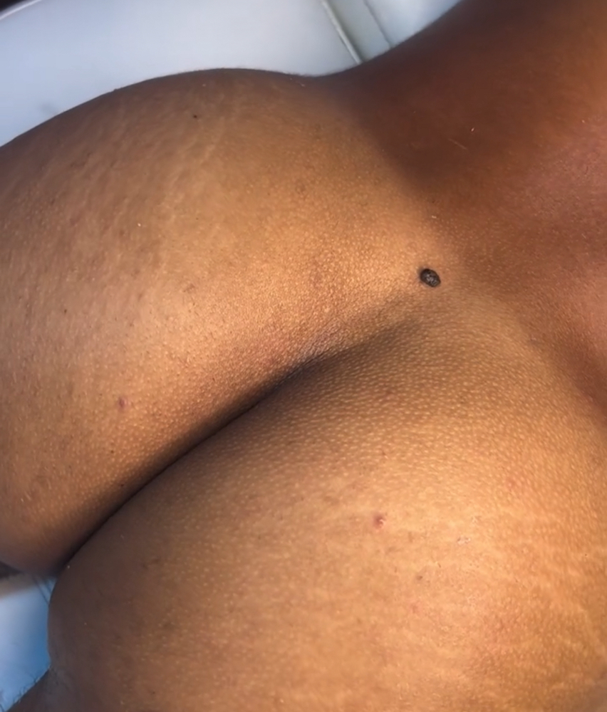 Gluteos