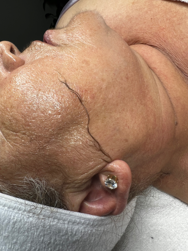 Dermaplaning Facial