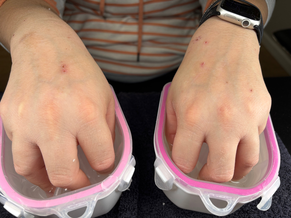 Nails Removal