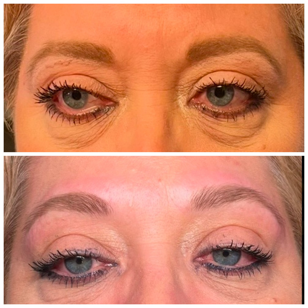 Eyebrow Lift
