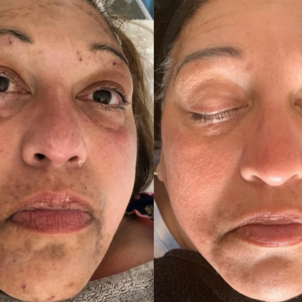 MICRO RESURFACE CORRECTIVE FACIAL at Lumiére Skin Science in Atlanta, GA