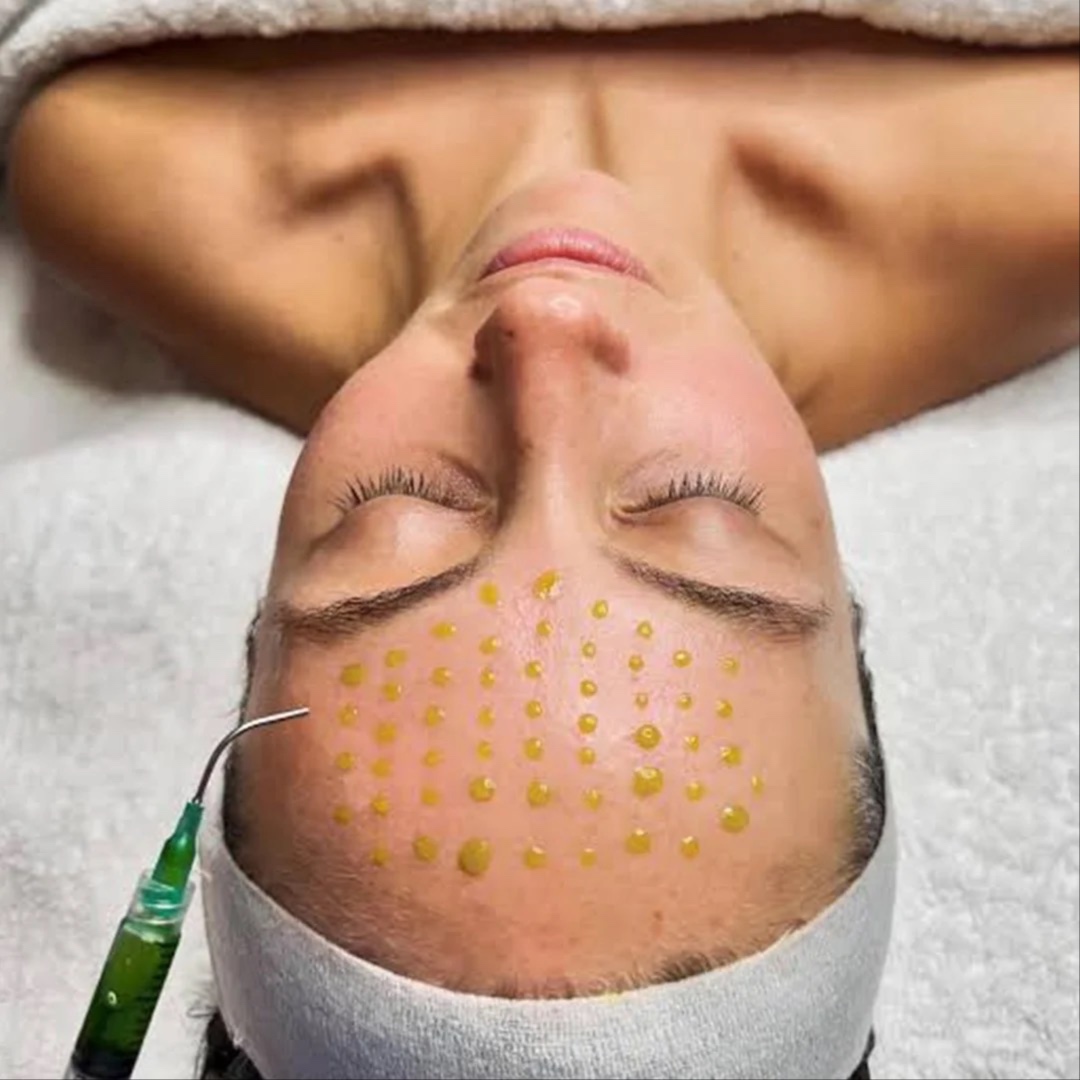 BioRePeel Treatment at Lush Skin Therapy in Mebane, NC