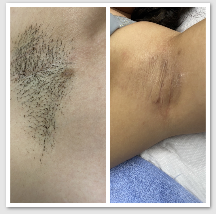 Peach Pit Underarm Wax w/ Underarm Facial
