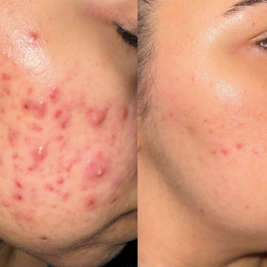 ACNE CONSULT + TREATMENT at NUBIA SKYN in San Dimas, CA