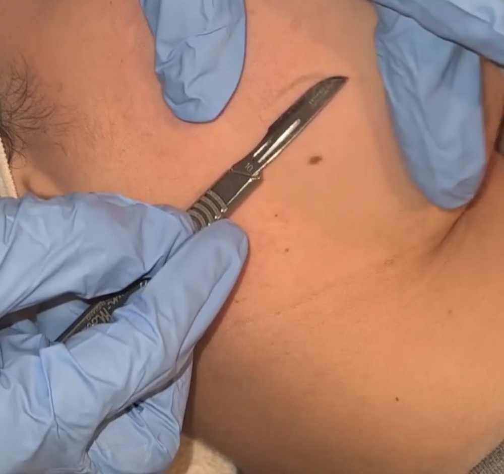 Dermaplaning Facial