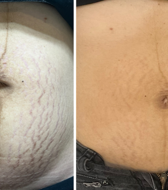 Alge Peel For Strech Marks