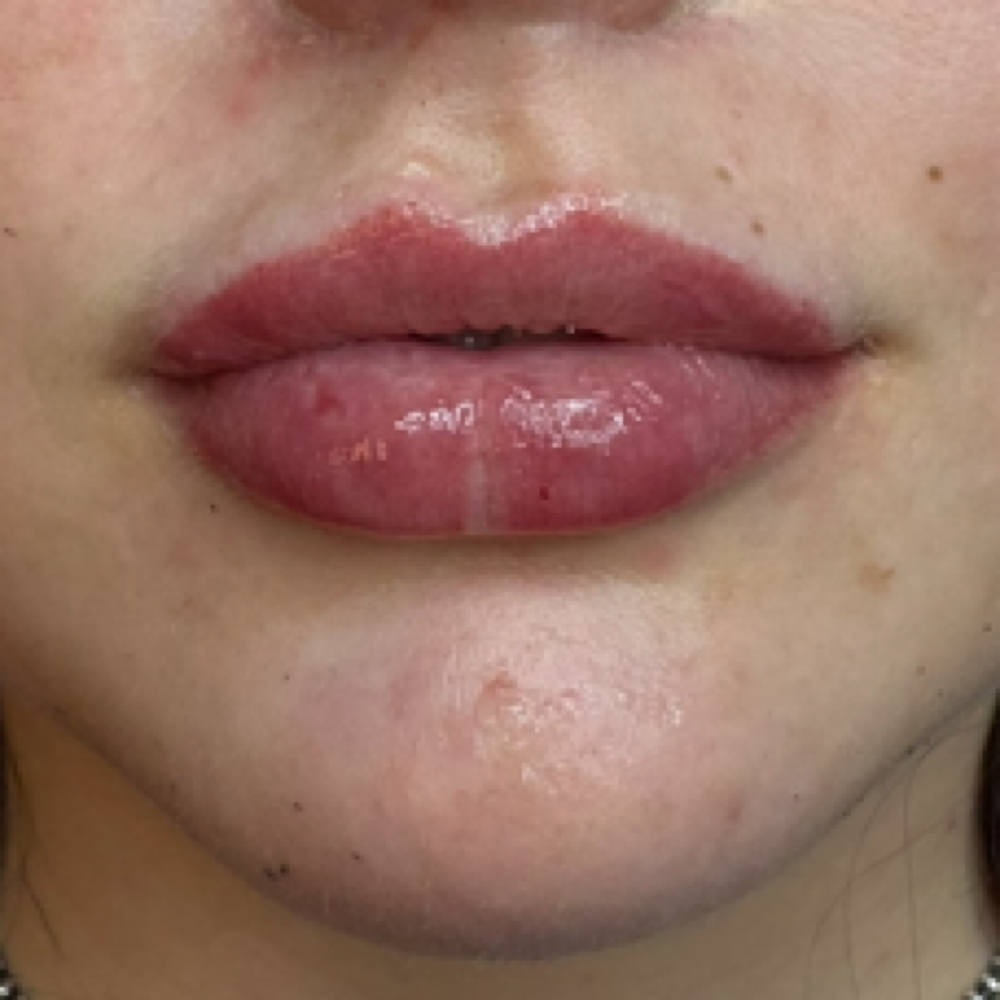 Lip Filler: Full Syringe