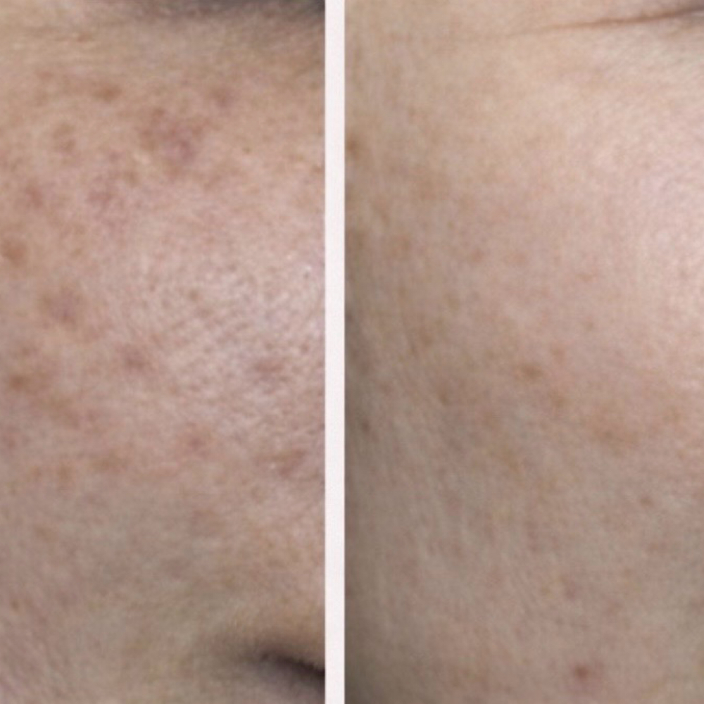 Procell Microchanneling at The Dermal Clinic in Lodi, CA