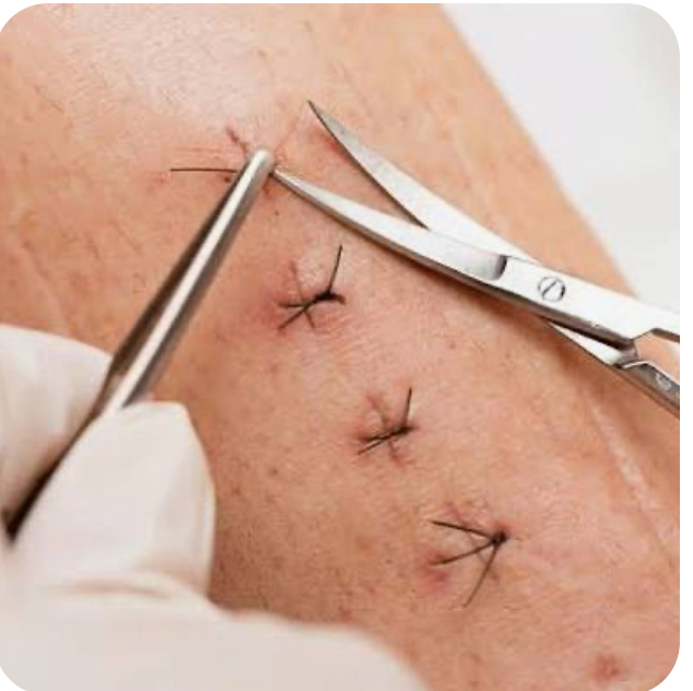 Stitch Removal
