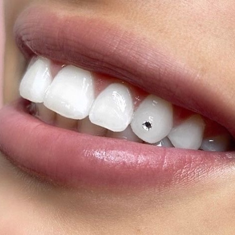 Tooth Gem(s) at Smiles by Mak in Casper, WY