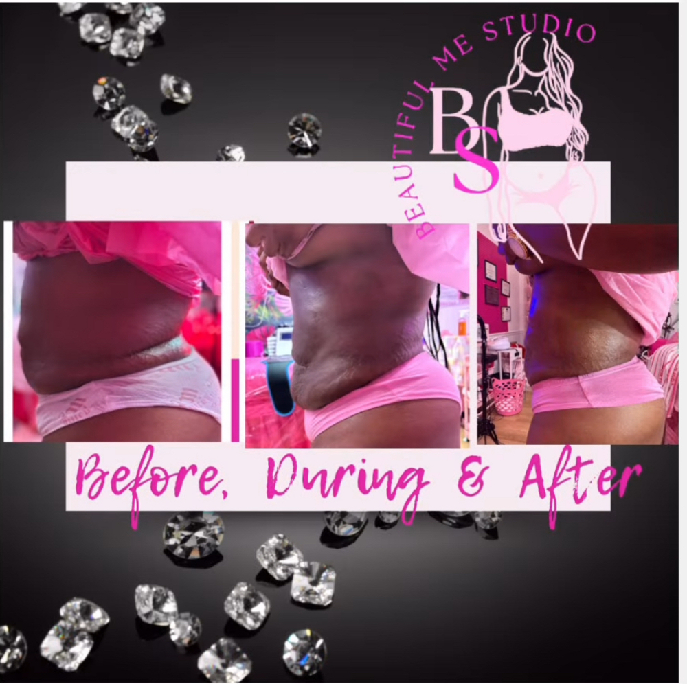 Stomach Or Back  Fat Blaster