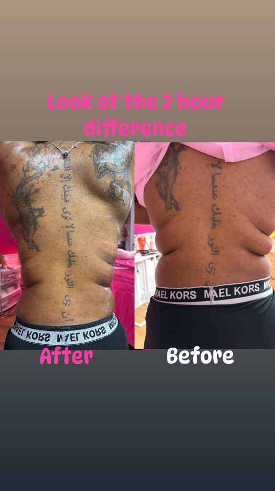 Stomach Or Back  Fat Blaster