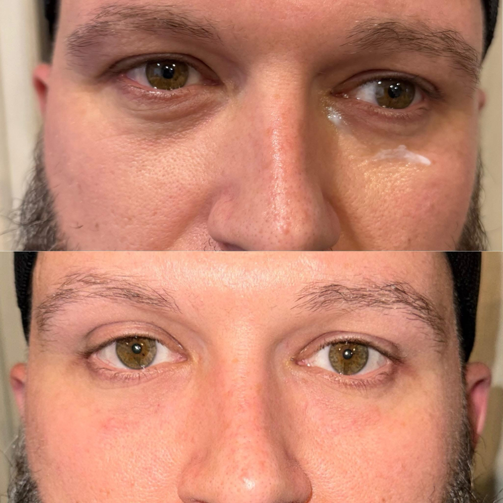 Under Eye Filler at Candice Stacy in Gilbert, WV