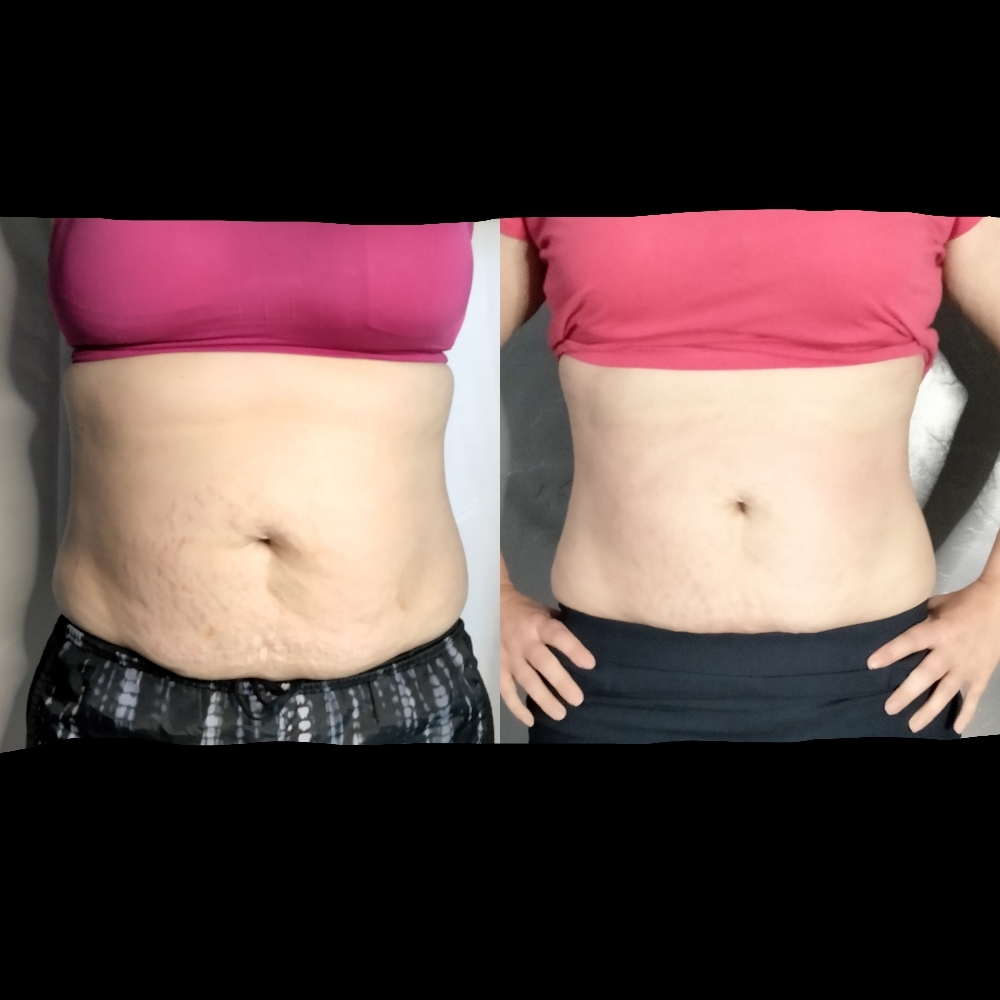 Laser Lipo/Cavitation Certification at Be You Renewal Spa in Tolleson, AZ