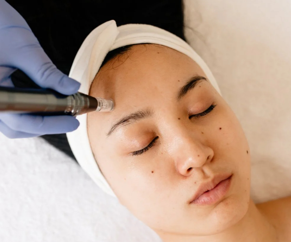 Microneedling