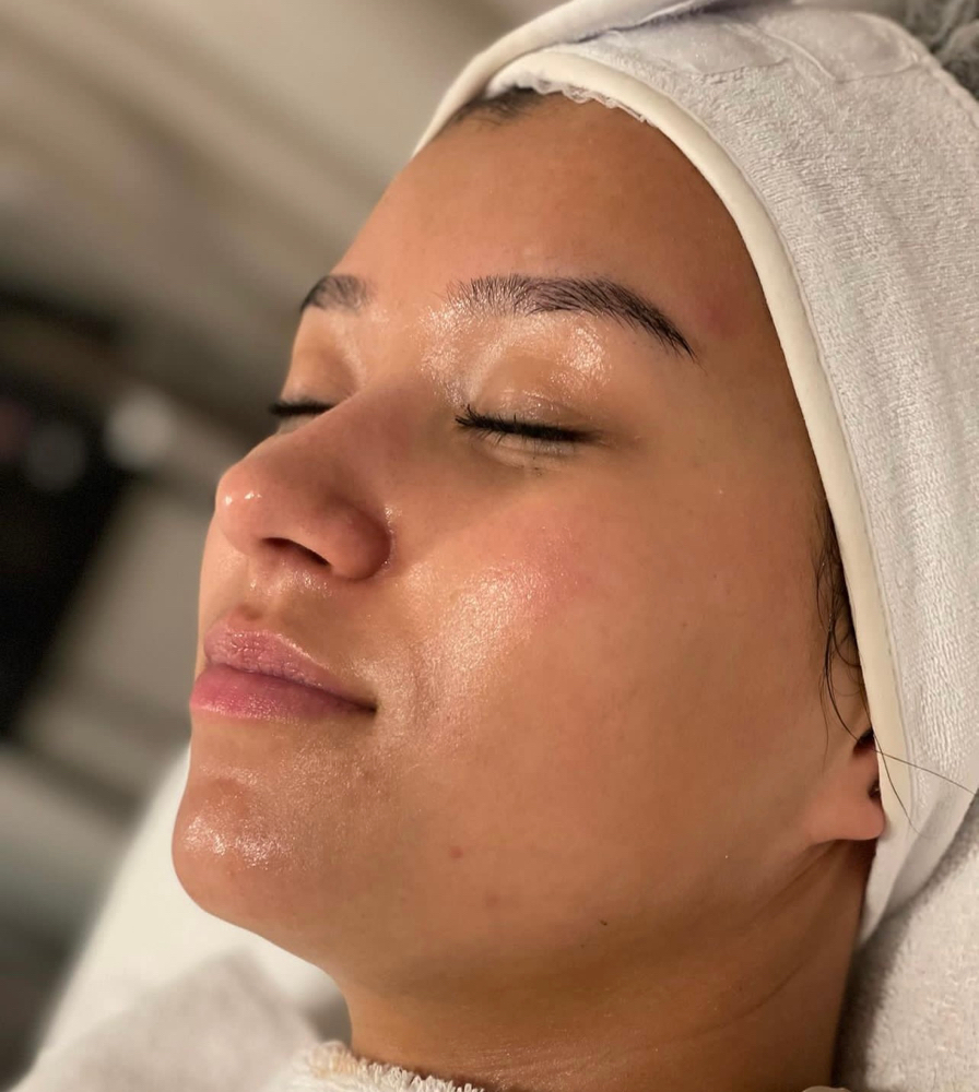 Chemical Peel