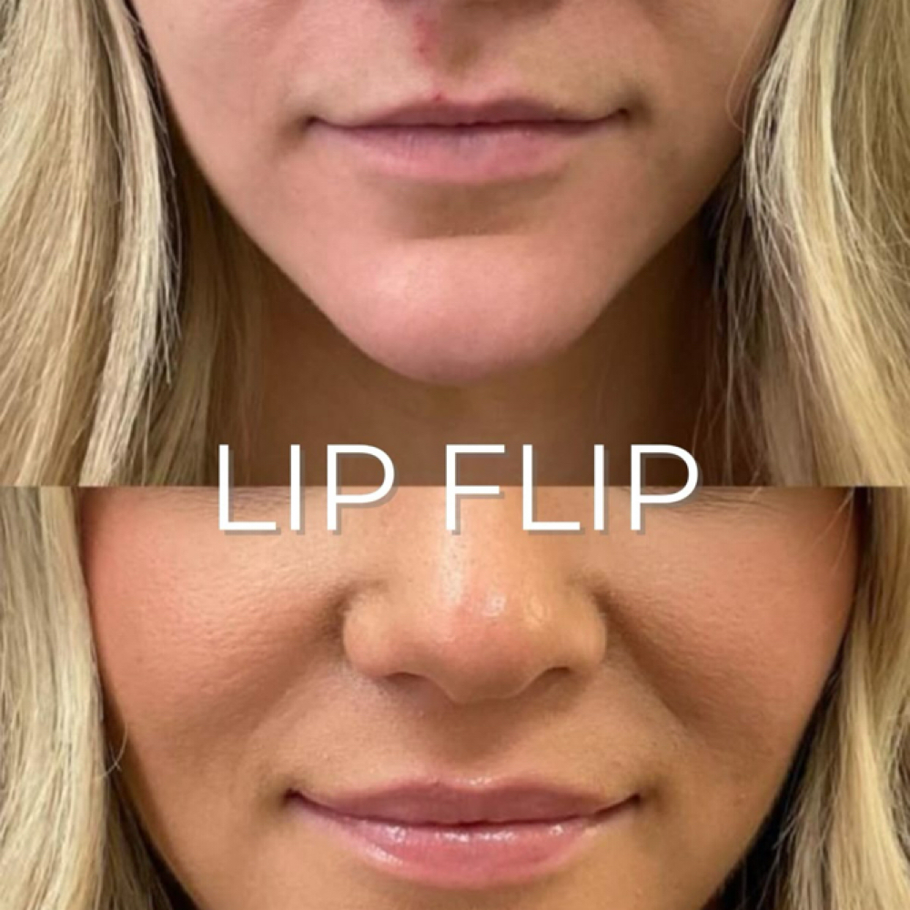 Botox- Lip Flip at Groomsology MedSpa in Mt Orab, OH