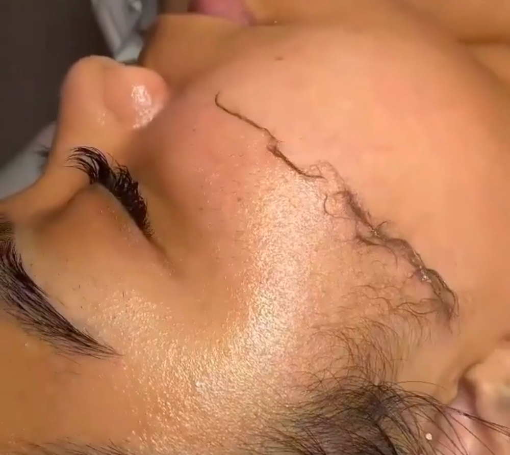 Dermaplaning Facial