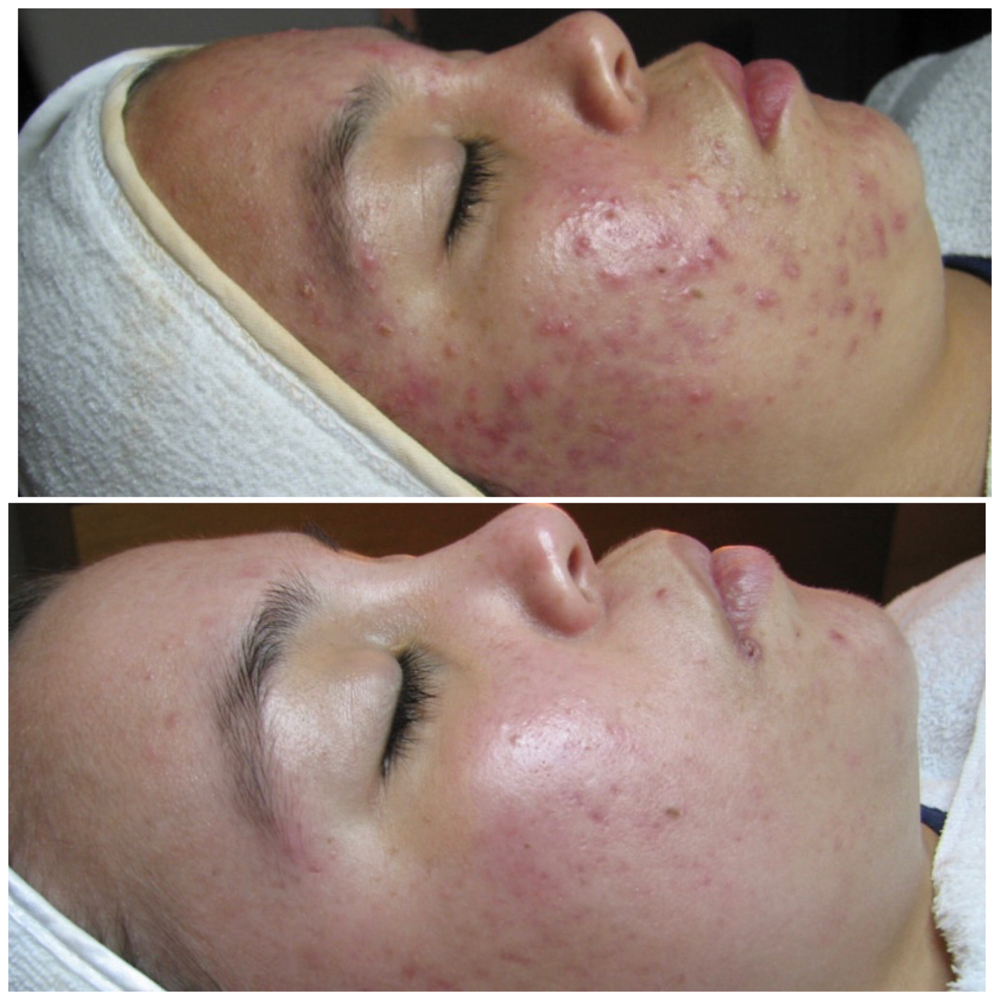 Acne Clearing Program Treatment