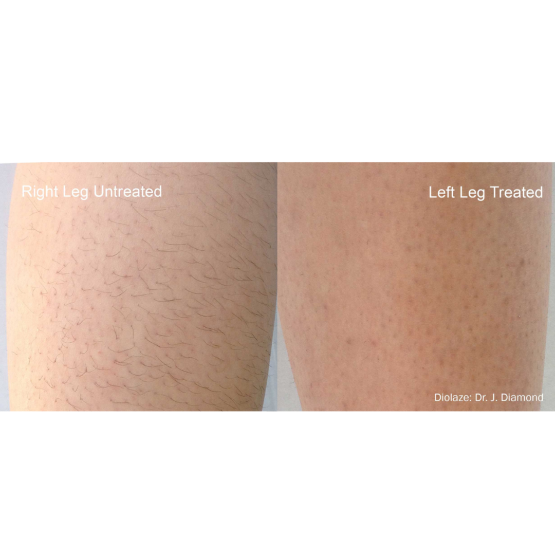 Laser Hair Removal at Meraki Artistry in Greenwood, IN