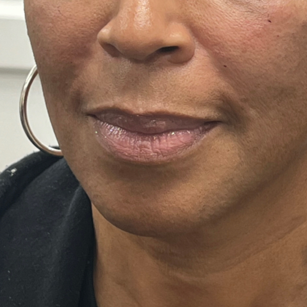 Nasolabial Filler at Nouvelle Vie Beauty in Cibolo, TX