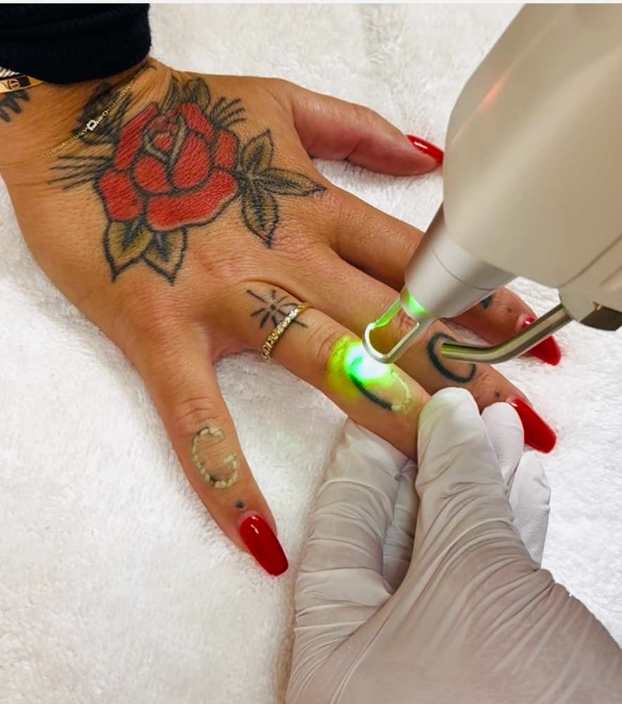 Tattoo Removal / Packages Available at Marina Novak in North Palm Beach, FL