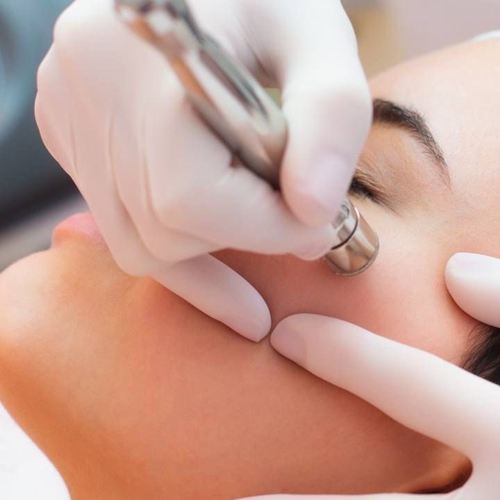 DIAMOND TIP MICRODERMABRASION at Remake Beauty Studio San Juan in San Juan, TX